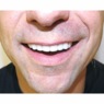 Instant Smile Veneer, , large