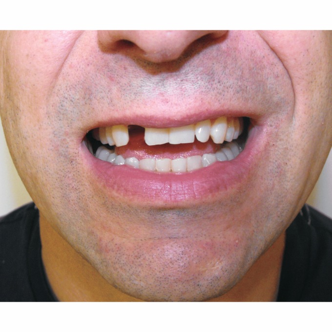 Instant Smile Veneer, , large